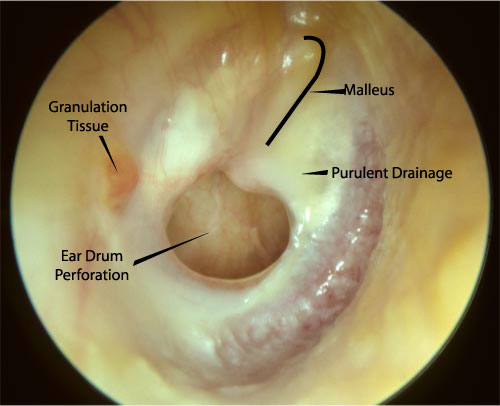 Sixteen year old with draining ear for several years.