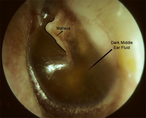 long standing fluid in the middle ear