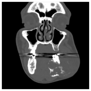 Scan of Marcus King's Jaw