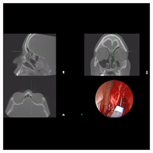 image from UTHealth ORL is the First in the U.S. to Use New Sinus Navigation System