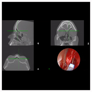 CT images of the sinus