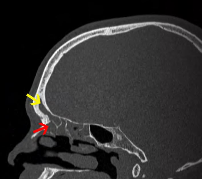 This sagittal sinus CT shows the opacified frontal sinus (indicated by the yellow arrow). At the time of surgery, the frontal sinus was filled with retained secretions and swollen tissue. During surgery, tissue obstructing the frontal sinus drainage in the frontal recess (indicated by the red arrow) was removed. During the dissection, care was taken to preserve tissue at the outer walls of the frontal recess so that the sinus could resume normal function.