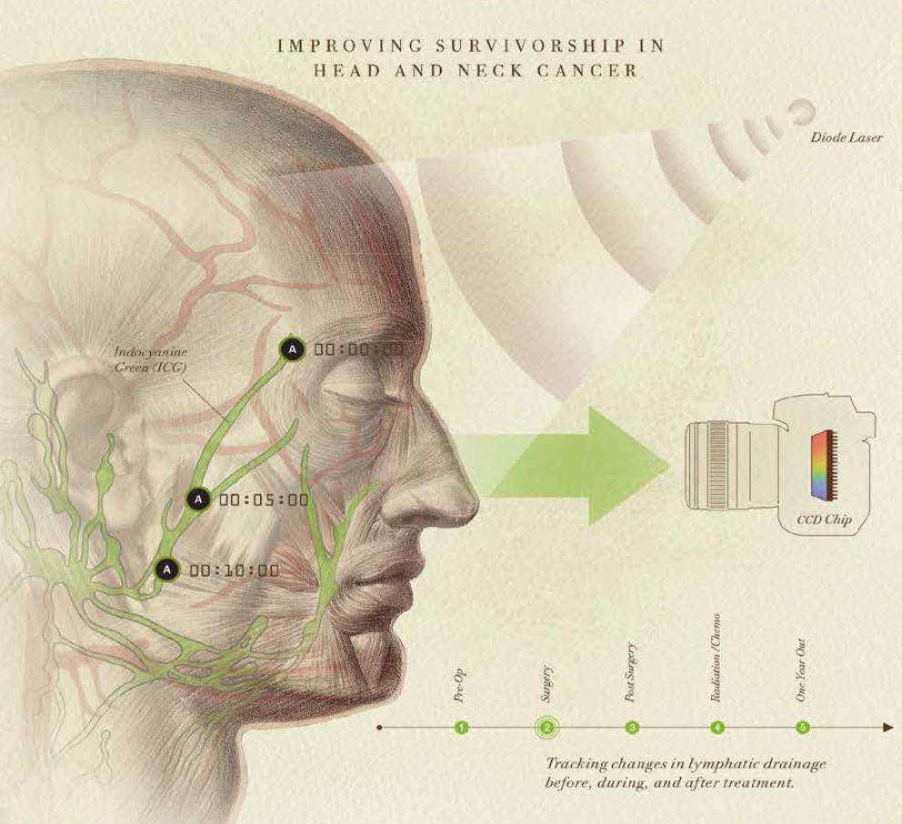 image from A Novel Lymphatic Imaging System and a Disease-focused Treatment Team Improve Survivorship in Head and Neck Cancer