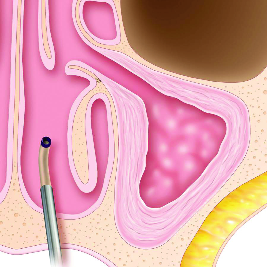 Maxillary Procedure step 4