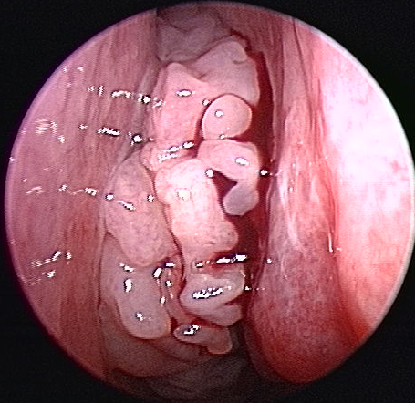 inverted papilloma in nasal cavity