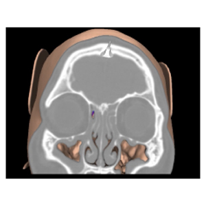 image from Herbert Ross: Among the First in the U. S.  to Benefit from a New Surgical Navigation System