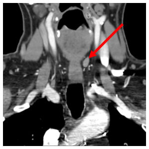 image from Revision Parathyroidectomy Using 4D CT for Localization