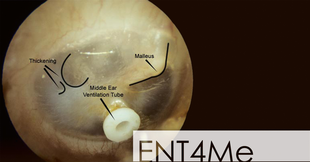 water stuck behind eardrum