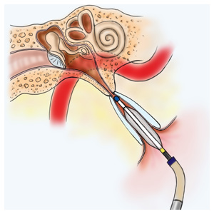 Diagram of balloon eustachian tuboplasty