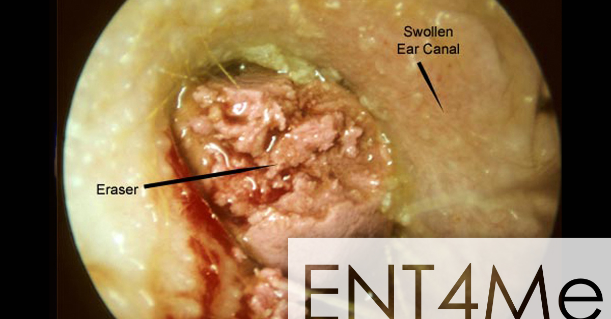 The Whole Ball Of Wax A Longer Than Normal Post About Your Cerumen Mcgovern Medical School