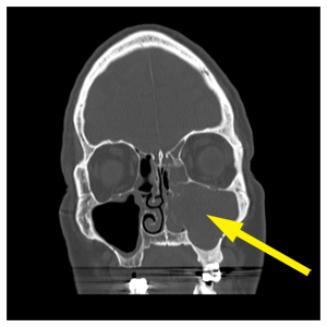 image from Minimally Invasive Surgery Provides Quick Relief of Sinusitis Caused by a Dental Infection