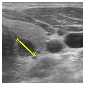 Ultrasound of secondary hyperparathyroidism