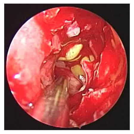 image from Intrathecal Fluorescein for CSF Leak Detection