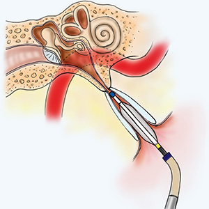 inner ear diagram showing Balloon Eustachian Tuboplasty