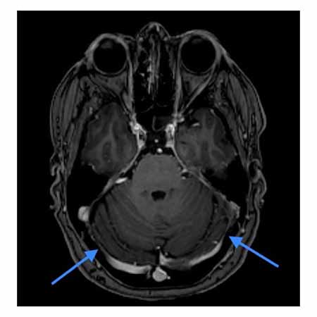 image from Dural Venous Sinus Narrowing in Patients with Spontaneous Anterior Skull Base CSF Leak