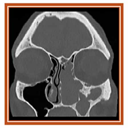 image from Can Machine Learning Identify the Tumor Attachment Site of a Sinonasal Inverted Papilloma?