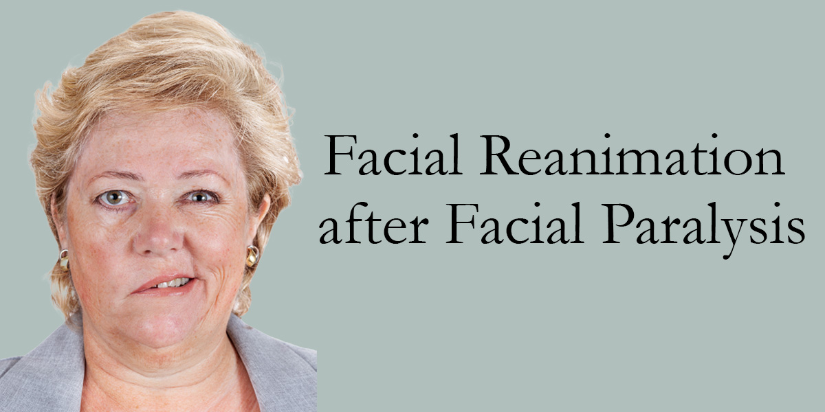 white woman with bell's palsy next to the words facial reanimation after facial paralysis