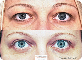 37 year old female 1 month after upper and lower blepharoplasty