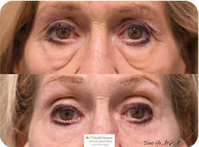 76 year old female 6 months after lower blepharoplasty