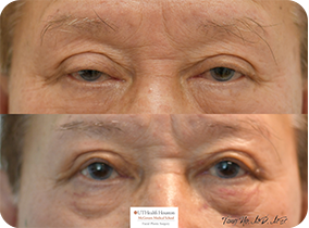 77 year old male 10 days after upper blepharoplasty and ptosis repair