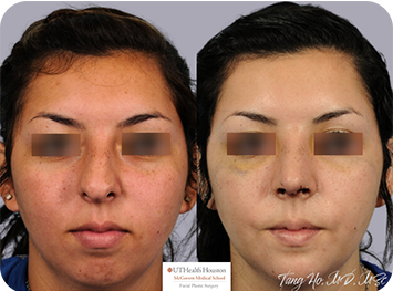 16 year old female Texas Center for Facial Plastic Surgery patient 2 weeks after rhinoplasty and chin implant