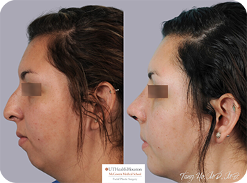 16 year old female Texas Center for Facial Plastic Surgery patient 2 weeks after rhinoplasty and chin implant