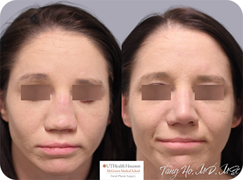 29 year old female Texas Center for Facial Plastic Surgery patient after rib graft rhinoplasty