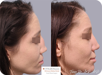 29 year old female Texas Center for Facial Plastic Surgery patient after rib graft rhinoplasty