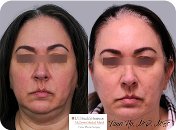 52 year old female Texas Center for Facial Plastic Surgery patient after thread lift and Kybella