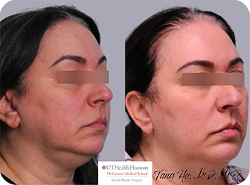 52 year old female Texas Center for Facial Plastic Surgery patient after thread lift and Kybella