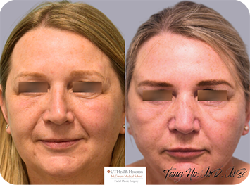 54 year old female Texas Center for Facial Plastic Surgery patient 3 weeks after thread lift