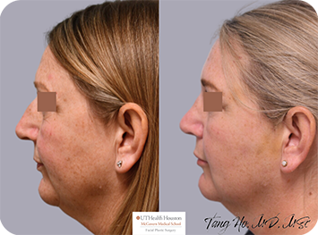 54 year old Texas Center for Facial Plastic Surgery patient female 3 weeks after thread lift