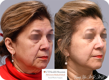 69 year old female Texas Center for Facial Plastic Surgery patient 3 months after lower face and necklift 