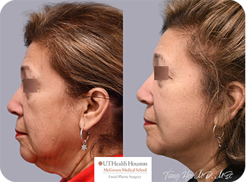 69 year old female Texas Center for Facial Plastic Surgery patient 3 months after lower face and necklift 