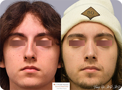 Nineteen Year Old Male After Revision Rhinoplasty