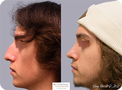 Nineteen Year Old Male After Revision Rhinoplasty