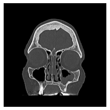 Coronal CT scan showing detailed bone structure of the skull, including eye sockets and nasal cavity.