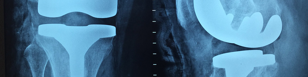 bone joint replacement