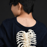 Congenital scoliosis treatment leads to rock-solid success - Kai Weir