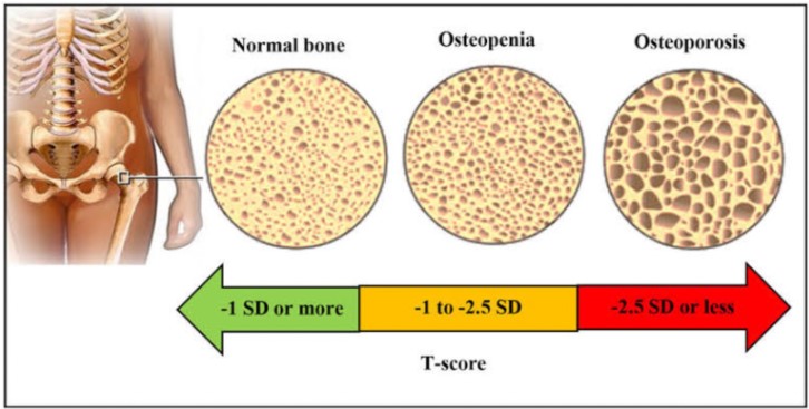 osteopenia score