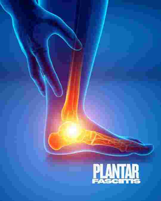 plantar fasciitis
