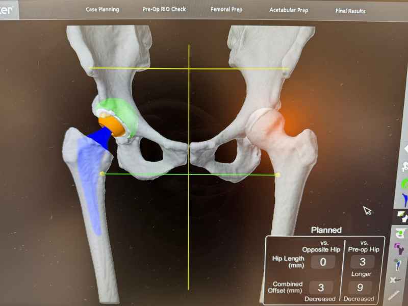 Outpatient robotic-assisted anterior hip replacement imaging