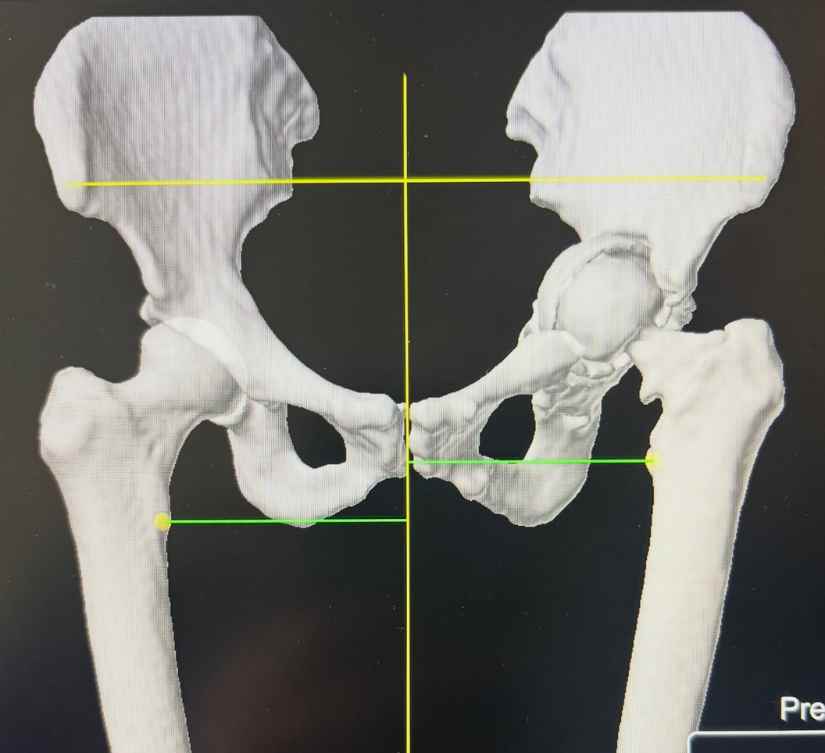 hip replacement revision surgery planning