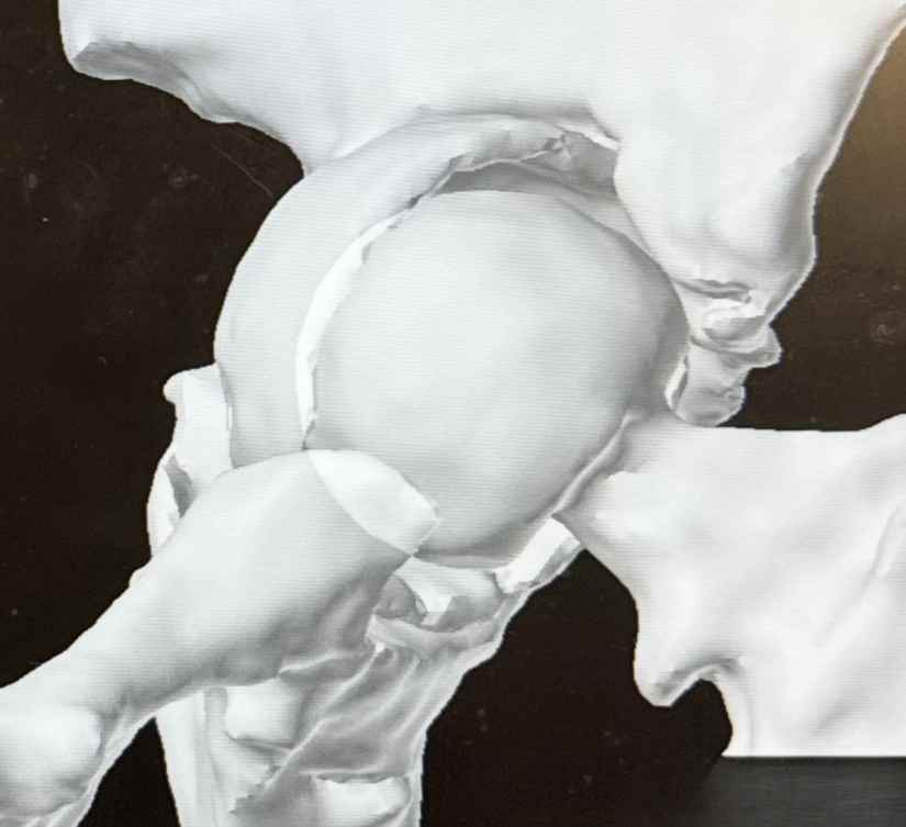 Cup implant loosening and eroding into the pelvic bone.