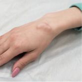 ganglion cyst