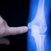 Panner Disease (elbow)