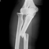 Radial Head Fractures of the Elbow