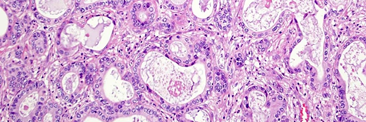 H&E of lung pathology