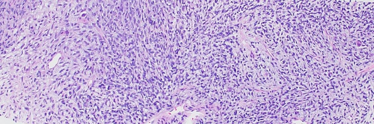 H&E rhabdomyosarcoma