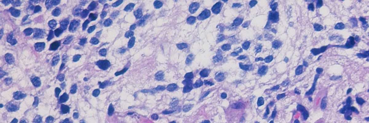 H&E of neuropath tumor